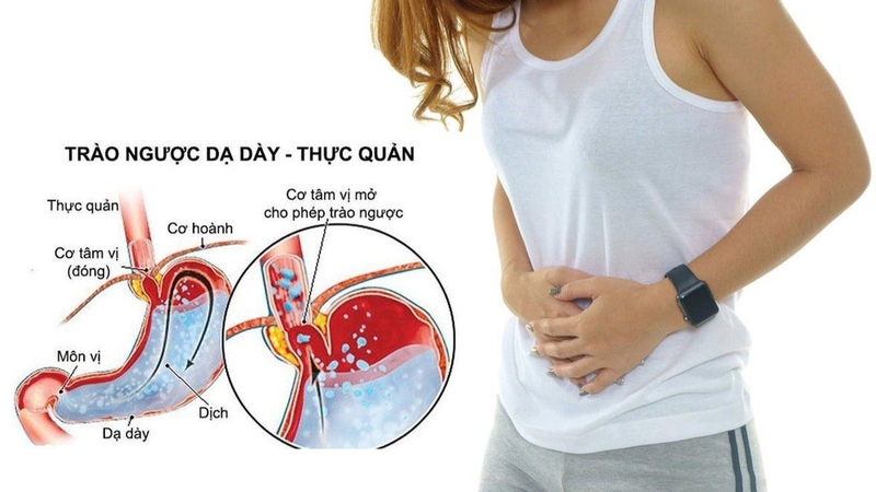 Nguyên nhân dẫn đến cảm giác nghẹn ở thực quản và cách xử lý - 2