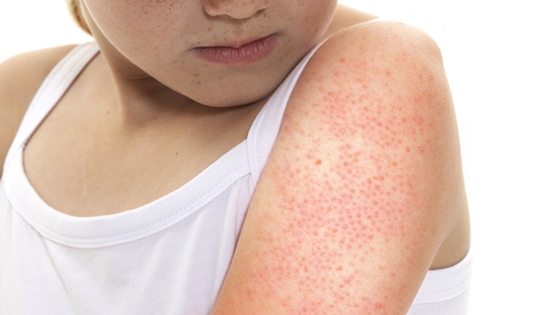 Nguyên nhân dẫn đến mụn nhọt ở trán là gì? Cách trị mụn nhọt tại nhà an toàn và hiệu quả 3