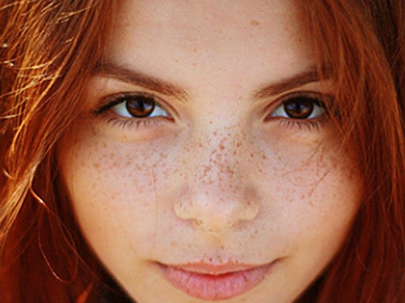 Nguyên nhân nào làm tàn nhang xuất hiện ở tuổi dậy thì? 1