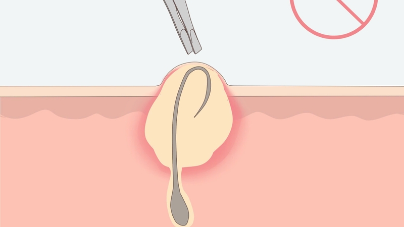 Mụn âm đạo: Nguyên nhân và cách điều trị hiệu quả 2