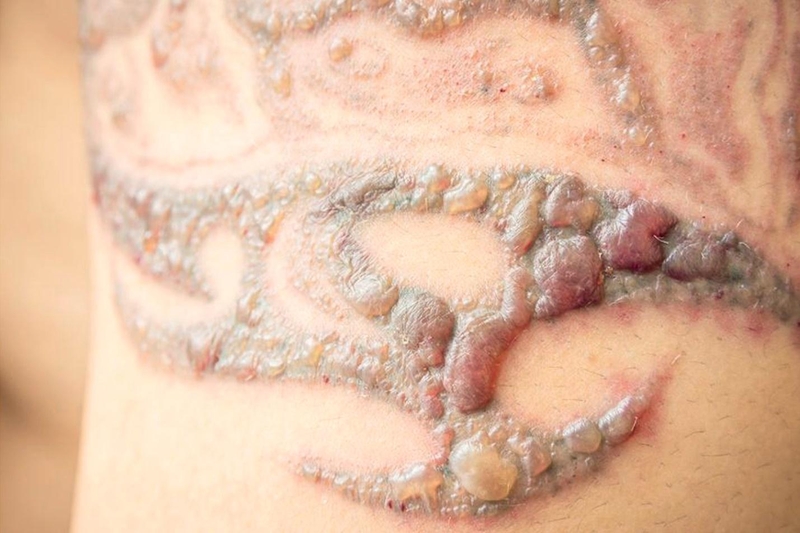 Nguyên nhân, dấu hiệu và cách khắc phục sẹo lồi khi xăm 2