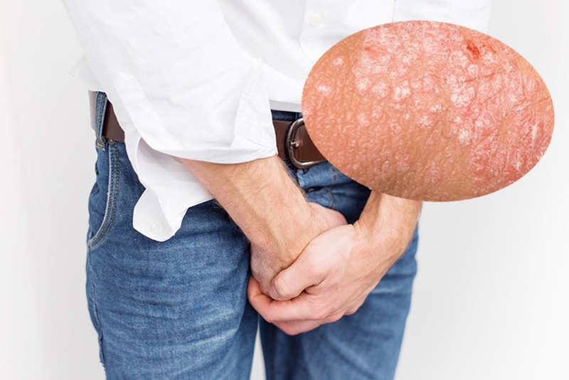 Nam giới cần cảnh giác hiện tượng dương vật nổi mụn