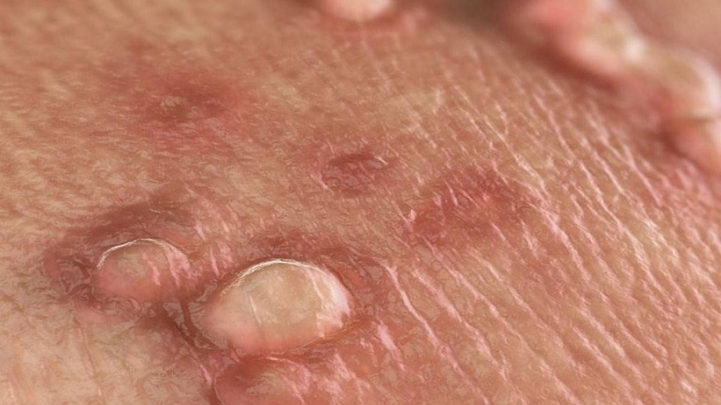 Nguyên nhân dương vật nổi mụn