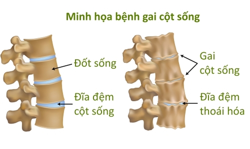 Điểm mặt 3 nguyên nhân gai cột sống và những biểu hiện thường gặp 1