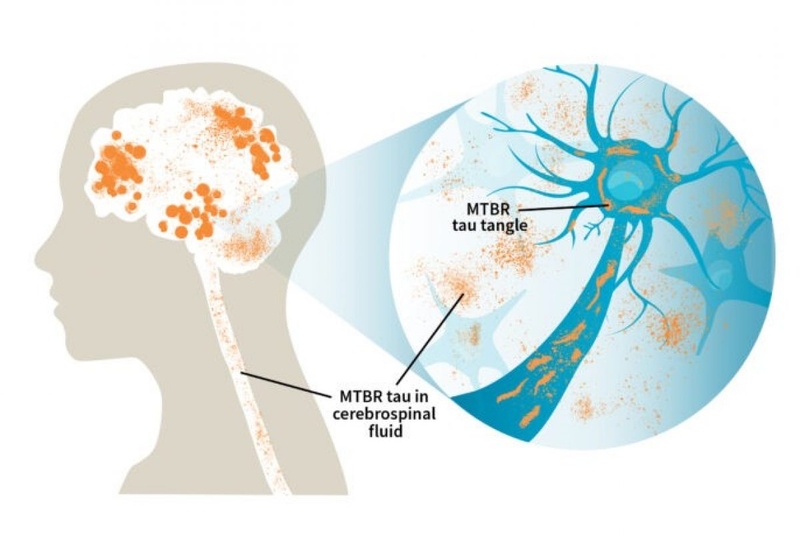 Nguyên nhân gây bệnh alzheimer và cách giảm thiểu rủi ro mắc phải 2