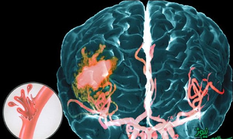Nguyên nhân gây bệnh mạch máu dạng bột là gì? Phương pháp điều trị thế nào? 1