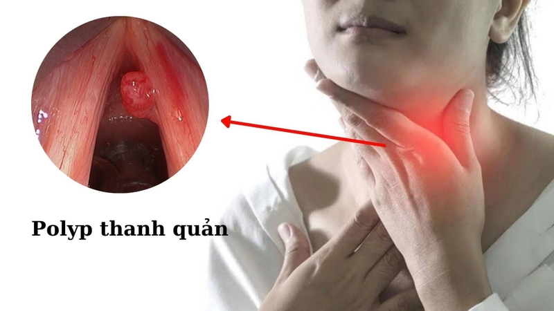 Nguyên nhân gây đau thanh quản và cách phòng ngừa 4
