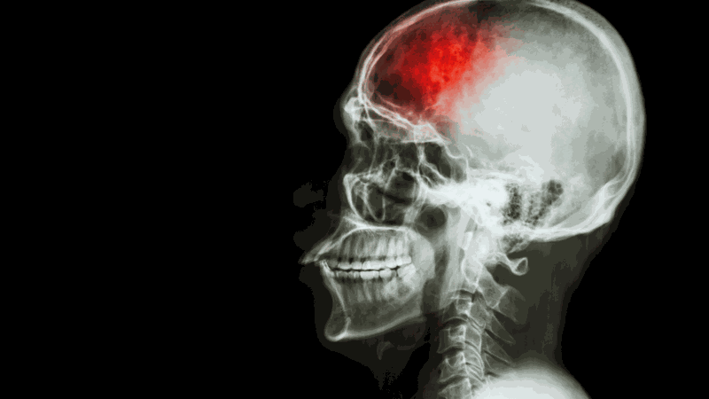 Nguyên nhân gây đột quỵ​ là gì? Cách phòng ngừa đột quỵ 3