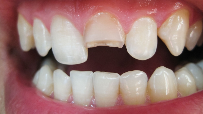 Không nên chủ quan khi bị gãy chân răng