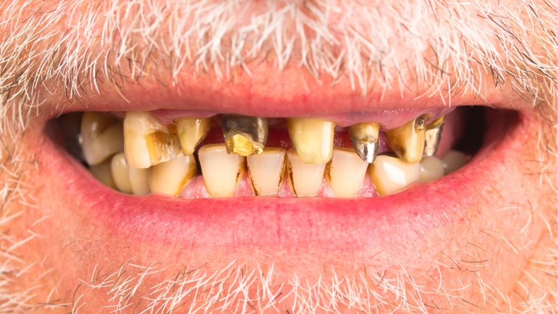 Ở người lớn tuổi, mô răng và cấu trúc quanh răng suy giảm theo thời gian khiến răng yếu hơn, dễ nứt, gãy hoặc rụng