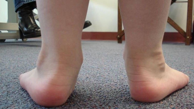 Trẻ bị hội chứng bàn chân bẹt thường có toàn bộ lòng bàn chân chạm đất