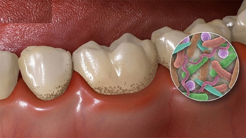 Nguyên nhân gây hôi miệng là gì? Lấy cao răng có hết hôi miệng không 2