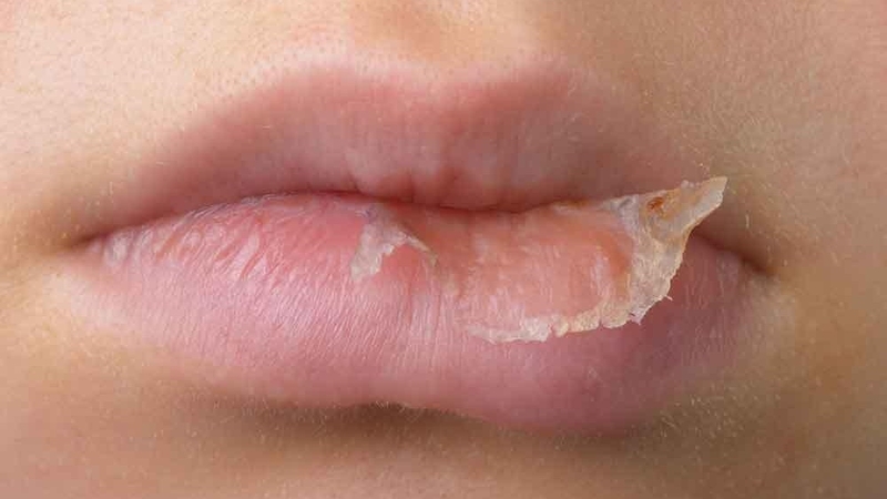Nguyên nhân gây khô môi là gì? 3