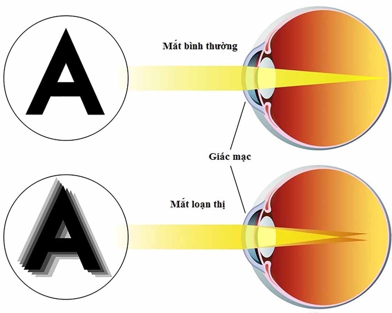 Nguyên nhân gây loạn thị là gì? Có điều trị được không? 1