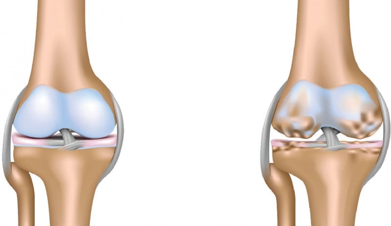 Nguyên nhân gây mất sụn khớp là gì? Sụn khớp có tái tạo được không? 3