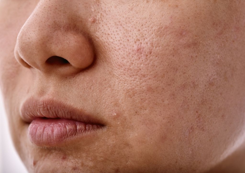 Nguyên nhân gây mụn đầu đen? Yoosun rau má có trị mụn đầu đen không?  1