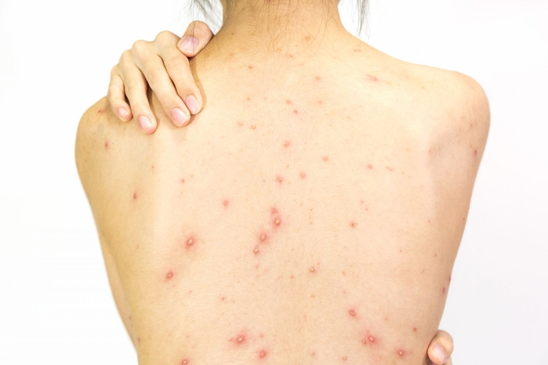 Nguyên nhân gây mụn trứng cá ở lưng là gì?1