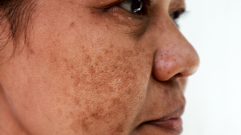 Những nguyên nhân gây nám tàn nhang có thể bạn chưa biết 1