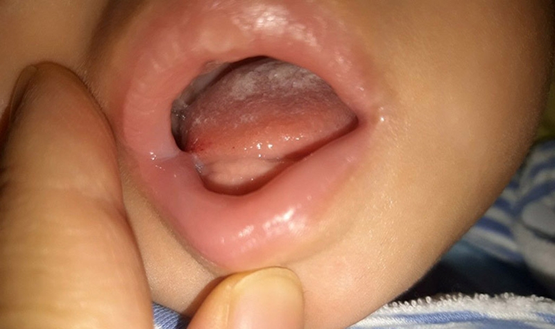 Nguyên nhân gây nên bệnh nấm vòm họng ở trẻ sơ sinh 1