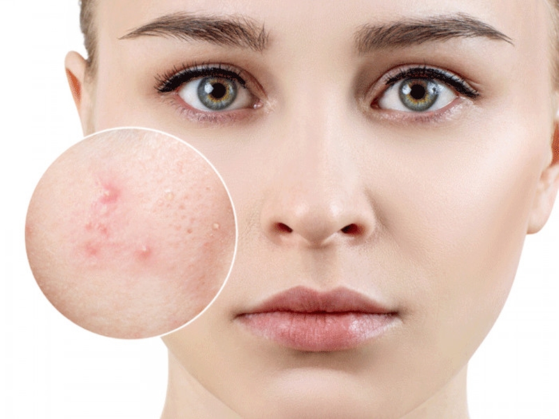 Nguyên nhân gây nên mụn đầu đen và mụn trứng cá và cách phòng tránh 1