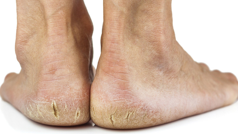 Nguyên nhân gây nứt gót chân và các biện pháp phòng ngừa 1