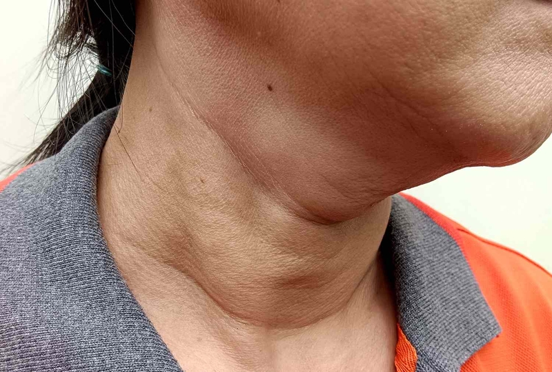 Nguyên nhân gây phình giáp? Tuyến giáp to có nguy hiểm không? 3