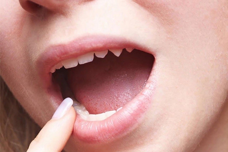 Nguyên nhân gây ra tình trạng nướu răng nổi cục thịt là gì? Cách chăm sóc nướu răng  2