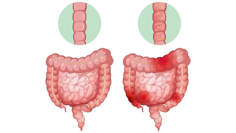 Nguyên nhân gây ra tình trạng sốt kèm đau bụng là gì? Cách xử trí 2