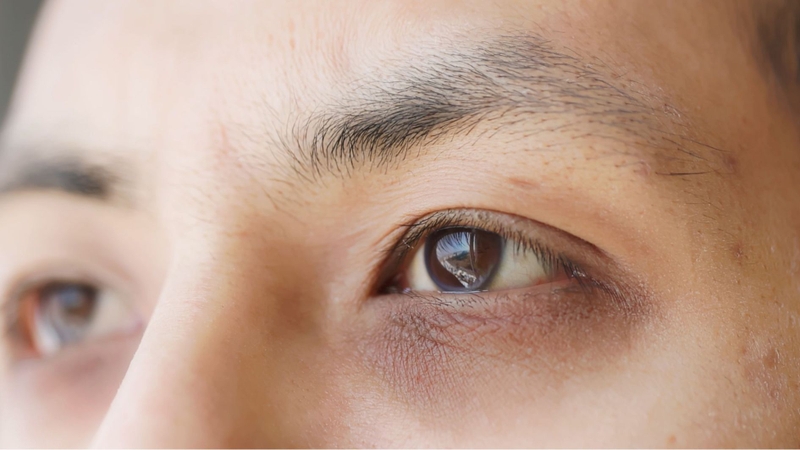 Mắt thâm là tình trạng vùng da quanh mí dưới trở nên sẫm màu