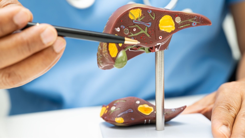 Quầng thâm mắt là dấu hiệu cảnh báo một số bệnh gan mạn tính như xơ gan, viêm gan