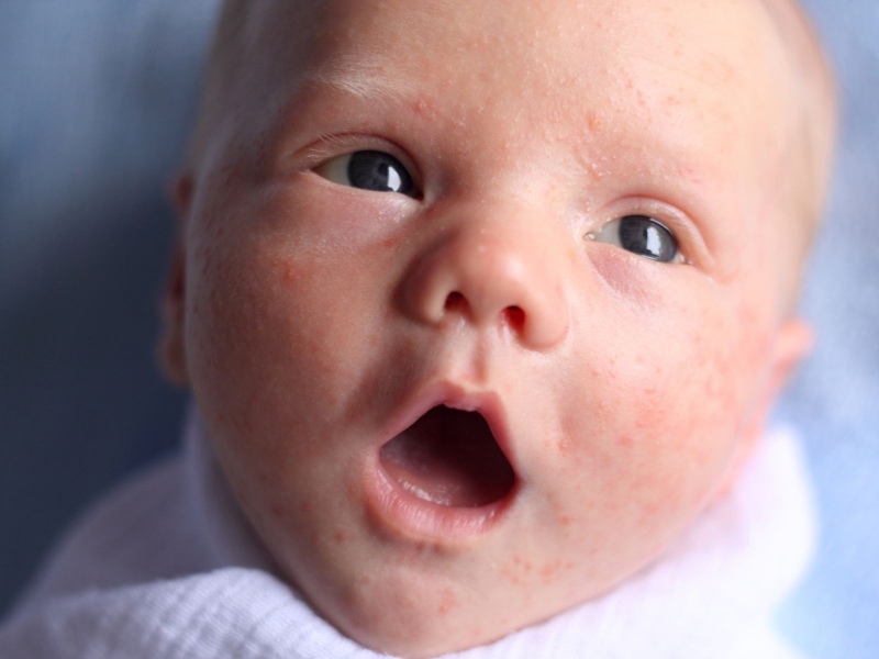 Nguyên nhân gây viêm nang lông ở trẻ em?1