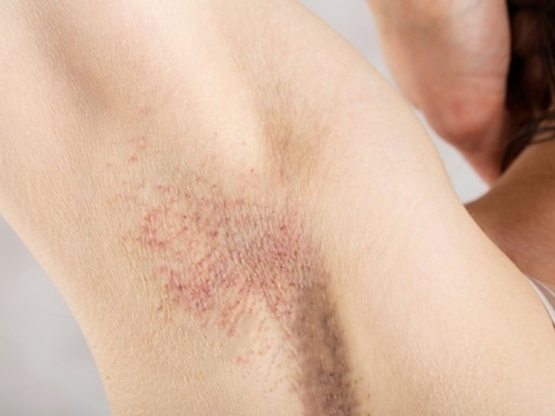 Nguyên nhân gây viêm nang lông vùng nách2