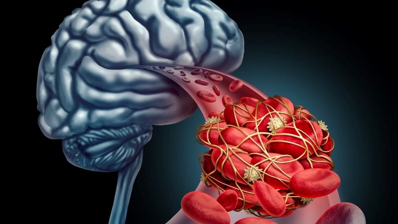 Nguyên nhân gây xuất huyết não mà bạn nên biết 1