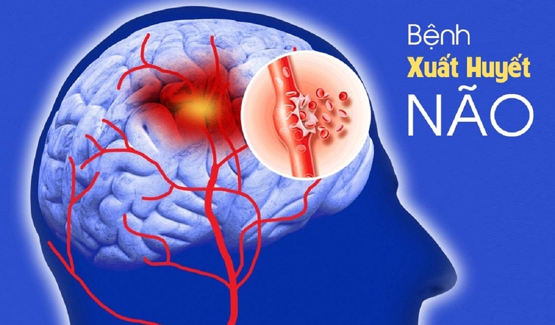 Nguyên nhân gây xuất huyết não mà bạn nên biết 1