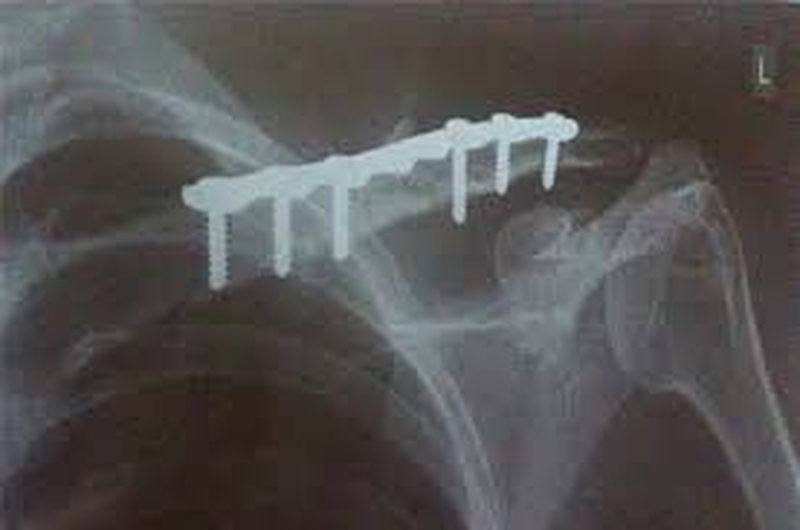 Nguyên nhân gãy xương đòn vai? Các phương pháp điều trị 2