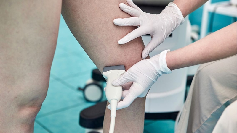 Siêu âm Doppler mạch máu chẩn đoán giãn tĩnh mạch