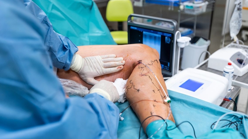 Điều trị giãn tĩnh mạch sớm để tránh biến chứng