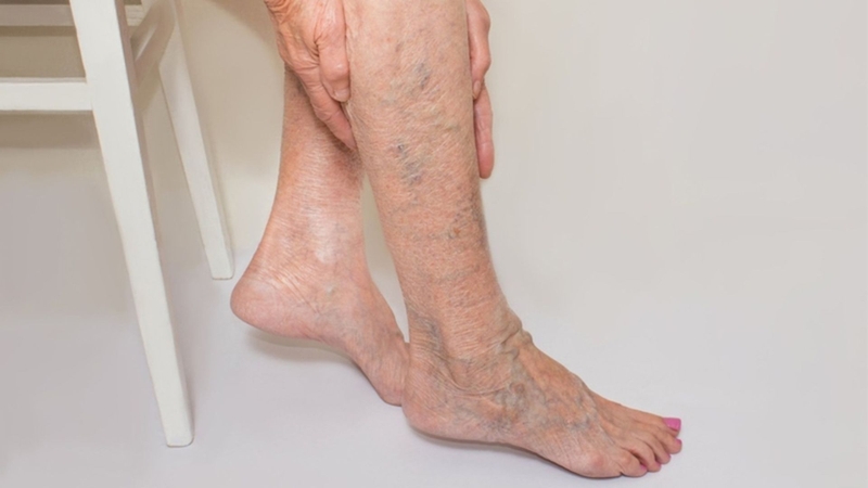 Giãn tĩnh mạch chân khiến chất lượng cuộc sống của người bệnh bị giảm sút
