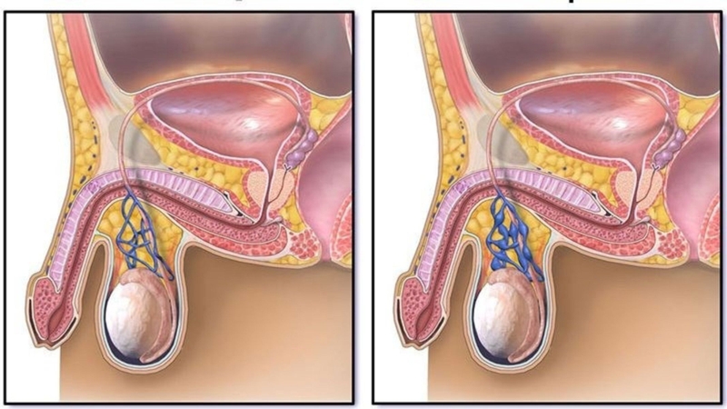 Giãn tĩnh mạch thừng tinh có nguy hiểm không?