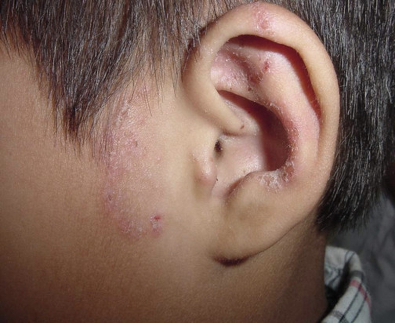 Nguyên nhân khiến hắc lào tái phát nhiều lần. 3 cách hỗ trợ trị hiệu quả hắc lào tái phát 2