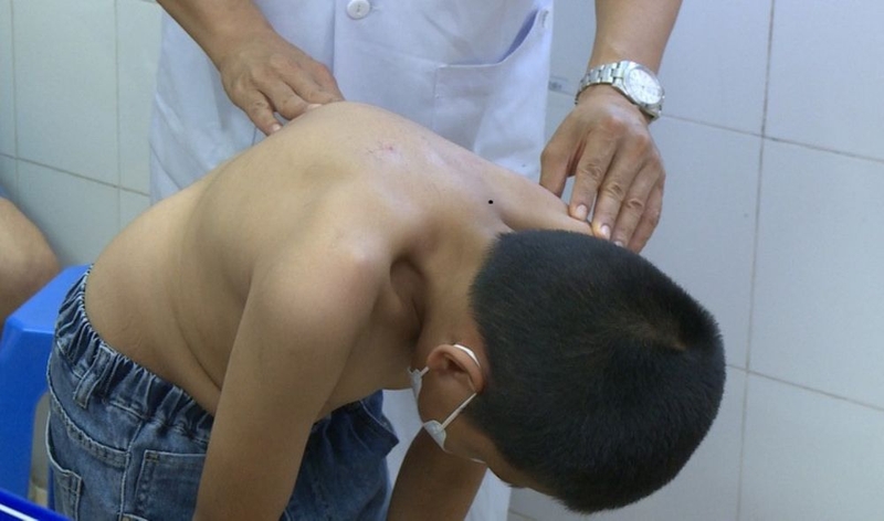 Nguyên nhân khiến trẻ bị lồi đốt sống lưng 2