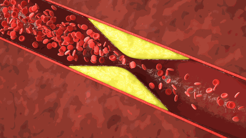 Máu nhiễm mỡ thường không có triệu chứng đặc hiệu, đặc biệt ở giai đoạn đầu