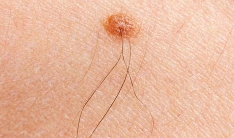 Nguyên nhân mọc lông ở đầu ti và cách cải thiện an toàn 2