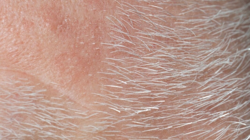 Nguyên nhân mọc lông trắng trên mặt? Mọc lông trắng có nguy hiểm không? 2