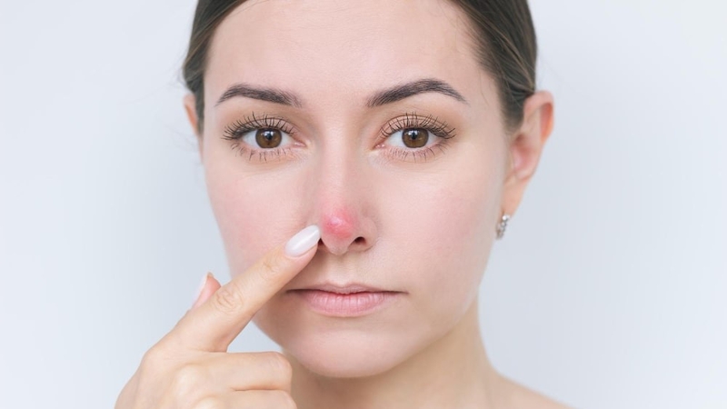 Nguyên nhân mọc mụn ở mũi phần lớn do bít tắc lỗ chân lông