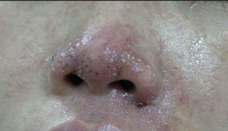 Nguyên nhân nâng mũi xong bị đau đầu và cách phòng tránh 3