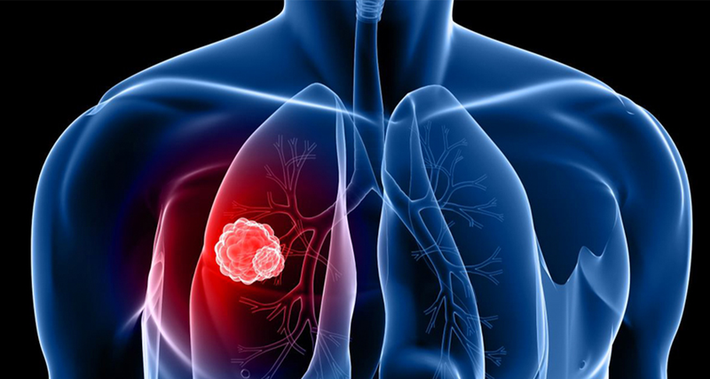 Nguyên nhân nào gây ra bệnh ung thư phổi?4