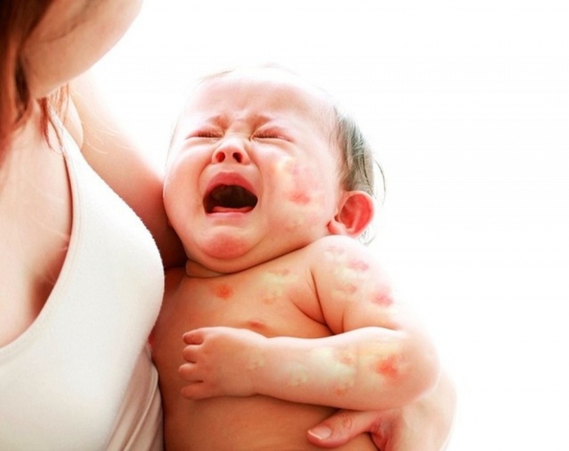 Nguyên nhân nào khiến bé dễ bị rôm sảy vào ngày hè? 3