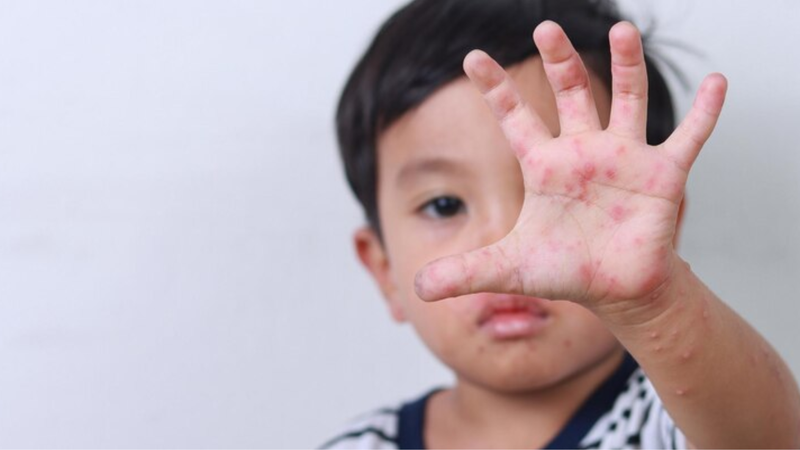 Trẻ em bị nổi mẩn đỏ ngứa khắp người do đâu? Cách điều trị và phòng ngừa 4