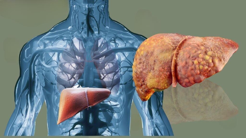 Nguyên nhân người ăn chay cũng có thể bị gan nhiễm mỡ 1